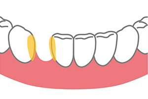 歯が抜けたところを矯正治療でどうにかできる？